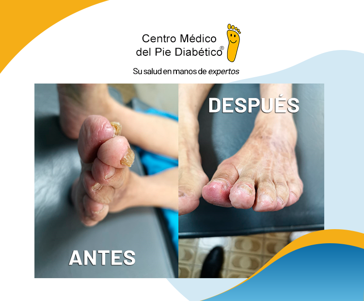 Onicomicosis – Centro Médico del Pie Diabético