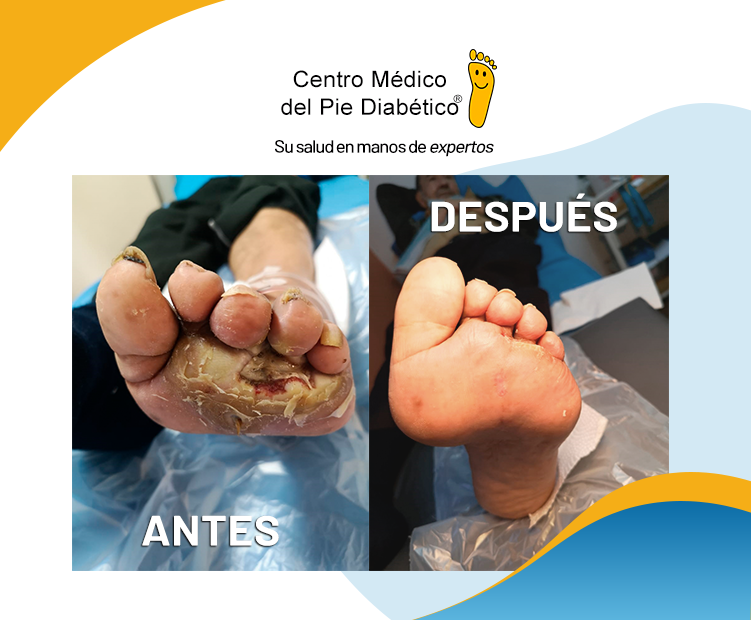 Ulceras Pie Diabético Centro Médico Del Pie Diabético 8495